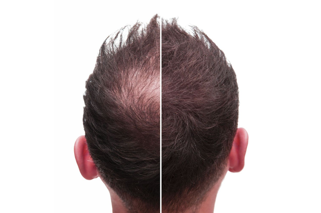 Caduta Capelli - Minoxidil - Hair Loss - Anticaduta